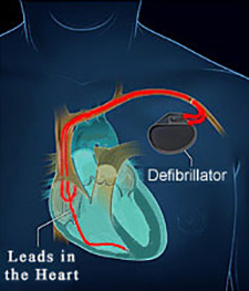 Defibrillator (ICD) Placement